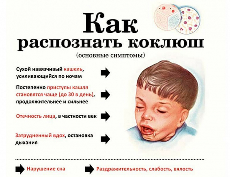 Долбит кашель. Ребенок кашляет. Основные симптомы коклюша. Симптомы при коклюше у детей.
